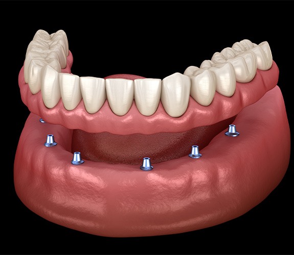 Digital image of implant dentures