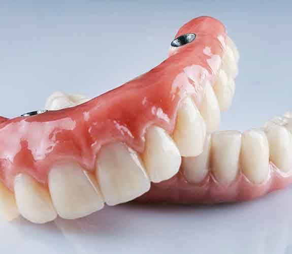 A full set of implant dentures