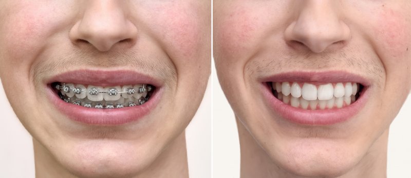 before and after braces  